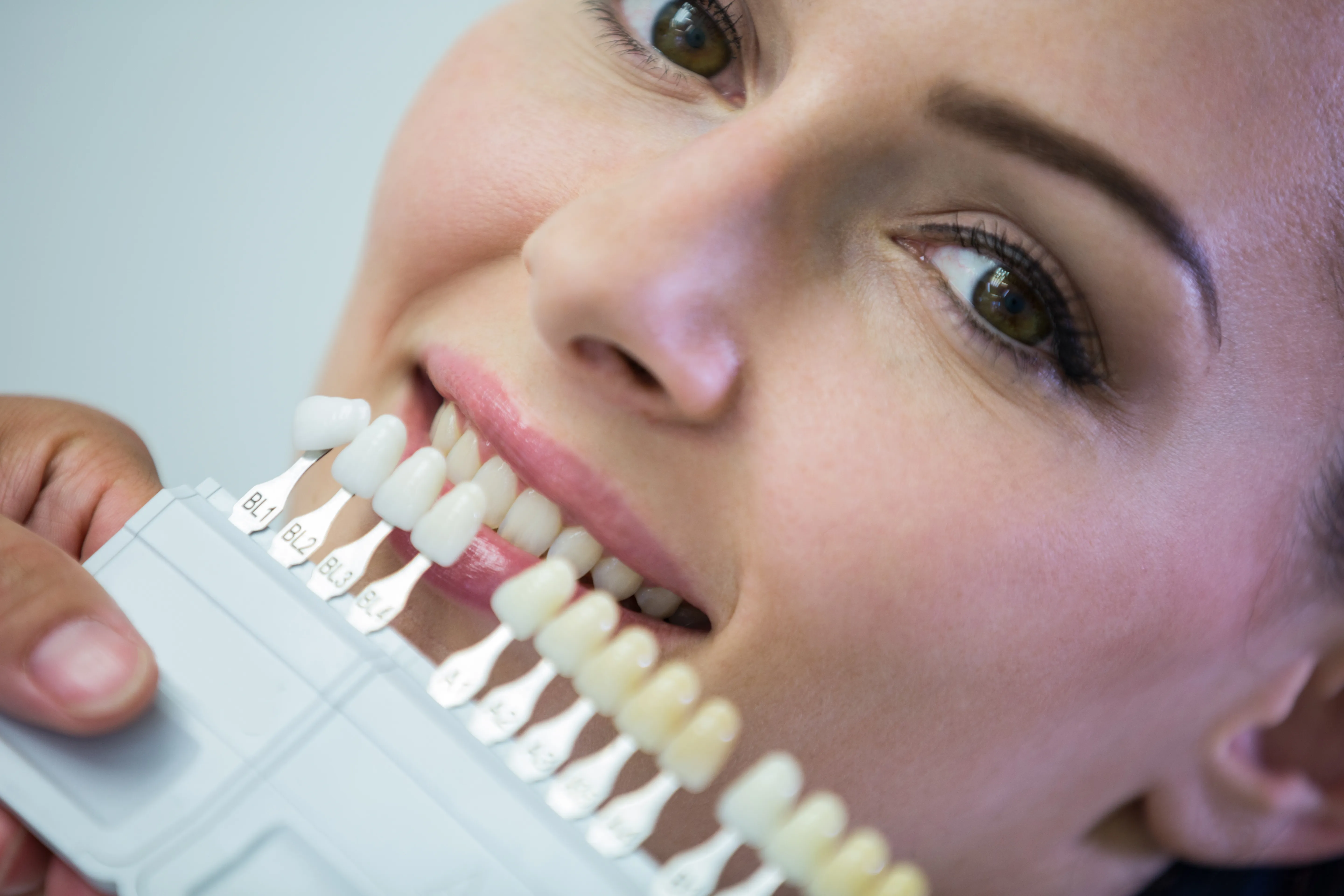 Veneers Service